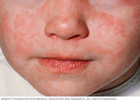 Pennsylvania has logged 943 measles cases across 39 counties and five associated deaths in 2026, as the US records nearly 3,700 infections — its worst outbreak since 1991.