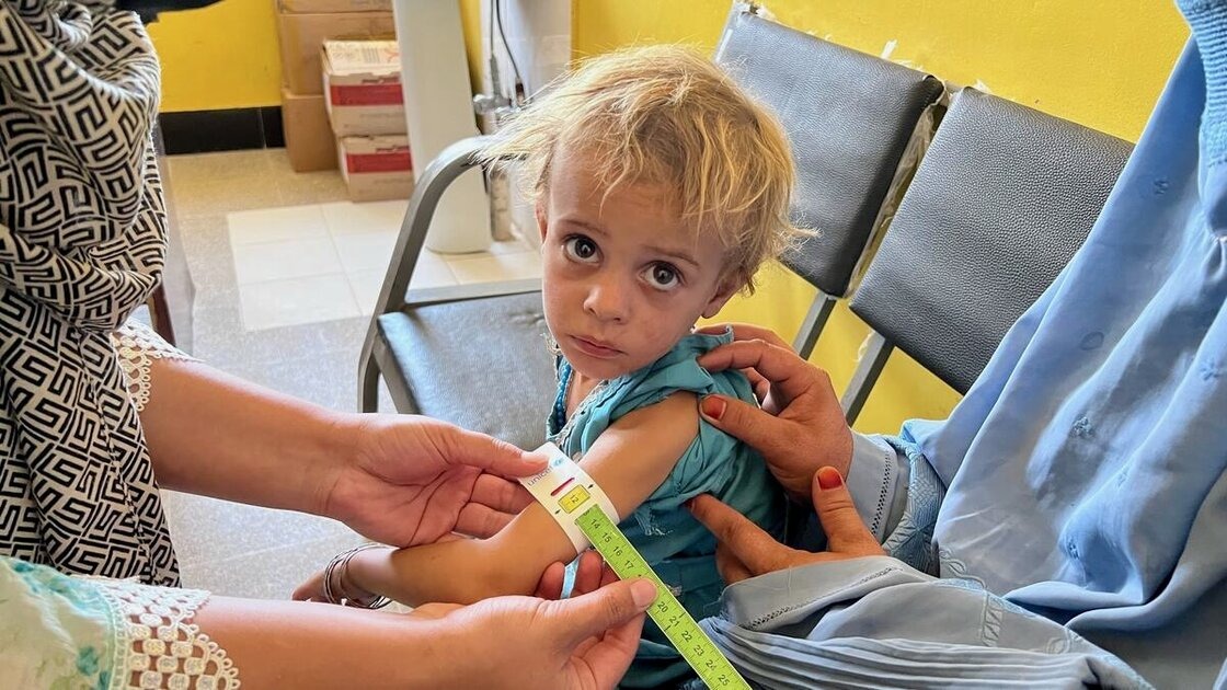 A child facing acute malnutrition in Afghanistan, where repeated droughts since 2018 have wiped out crops in Badghis province, forcing families to sell daughters as young as two into marriage to survive.