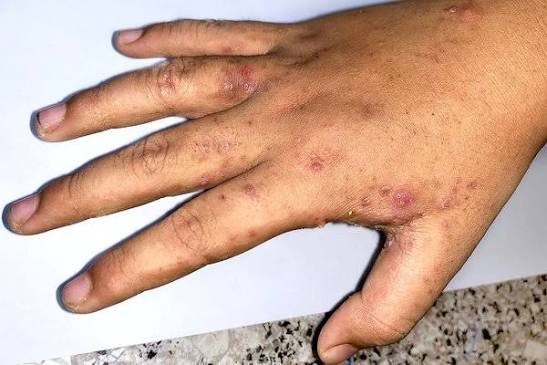Morriston Hospital is the third Welsh hospital to record a scabies outbreak since July, following cases at Glangwili Hospital in Carmarthen and Prince Philip Hospital in Llanelli.