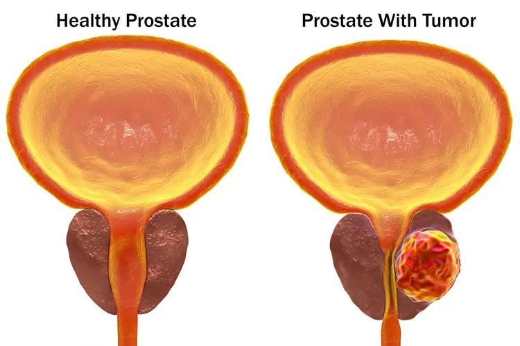 Five-session radiotherapy left far fewer men with erectile dysfunction or urinary incontinence than surgery, the eight-year Royal Marsden PACE-A trial found.
