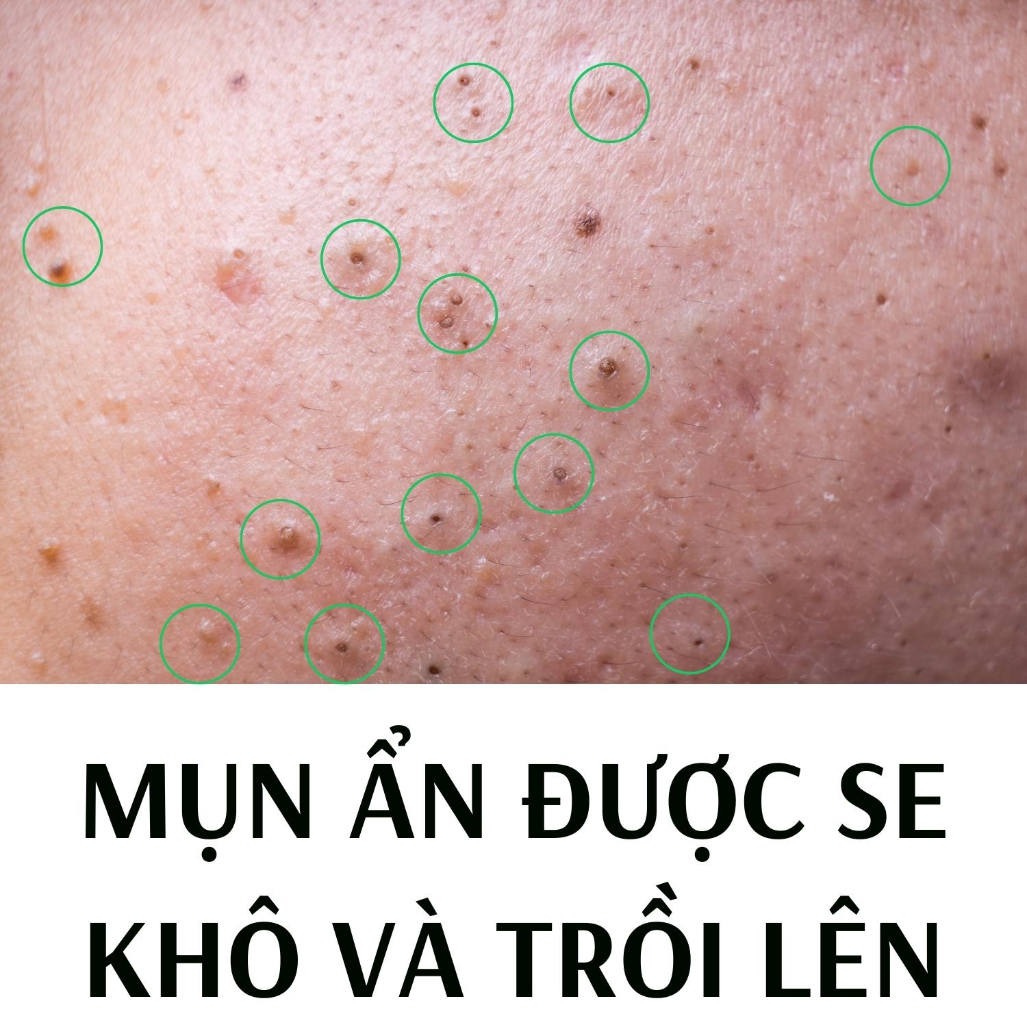 Bộ giảm Mụn ẩn ,Mụn đầu đen,Mụn thâm Doctor Care 