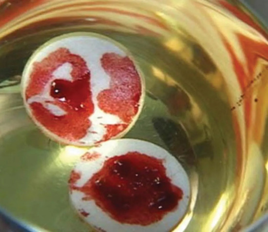 Heart Muscle Under Distress