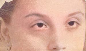 Who Could See Without Pupils