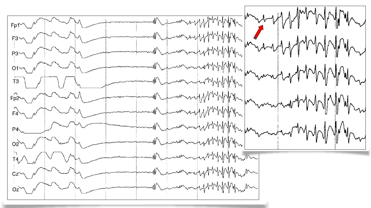 Epilepsia y síndromes epilépticos en perros y gatos.