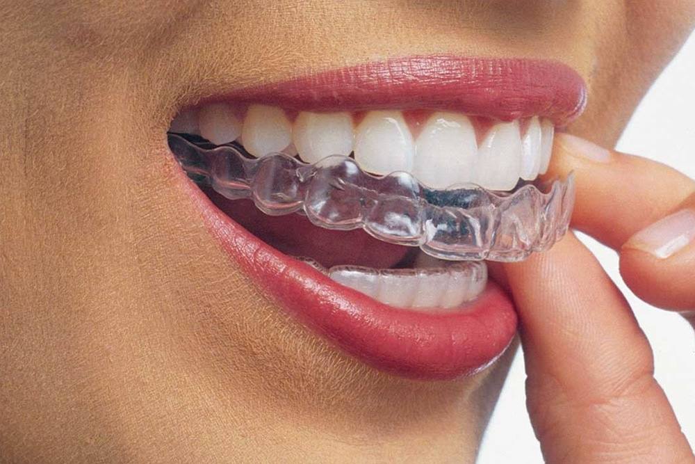 Aparelho de Dente Transparente