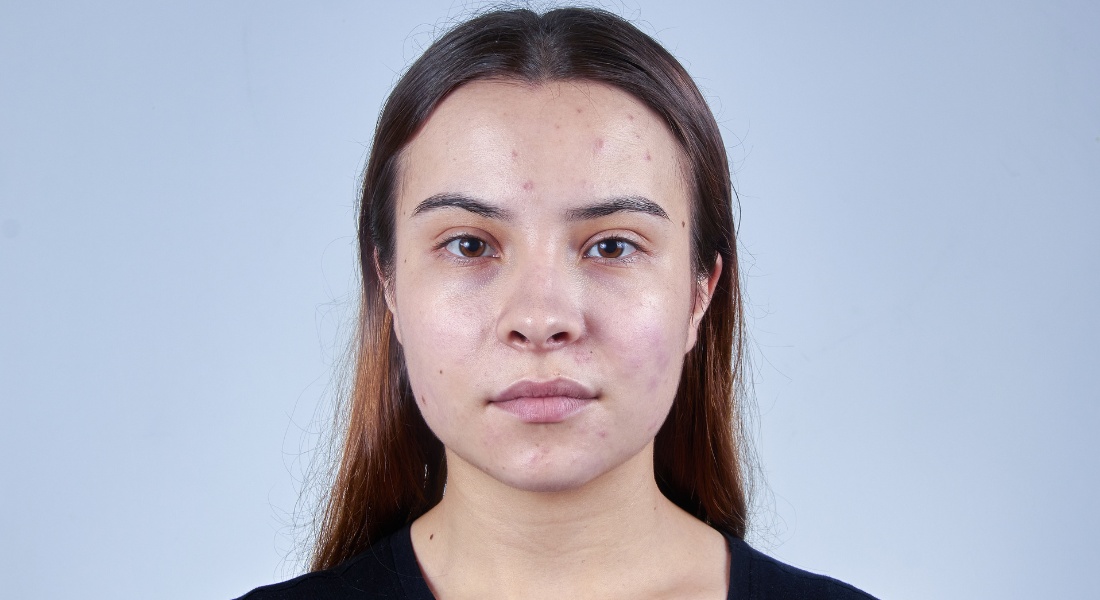 The Ultimate Guide to Managing Oily and Acne-Prone Skin: Tips, Treatments, and Skincare Essentials_3