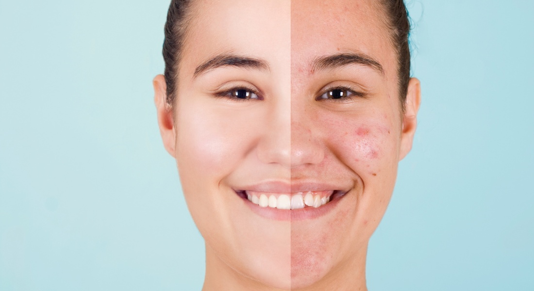 The Ultimate Guide to Managing Oily and Acne-Prone Skin: Tips, Treatments, and Skincare Essentials_0