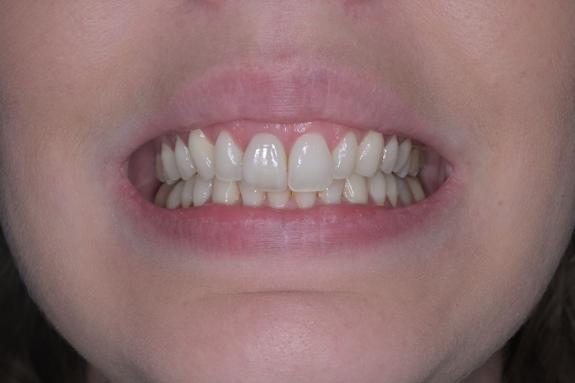 Invisalign, bielenie a 1 keramická korunka – po