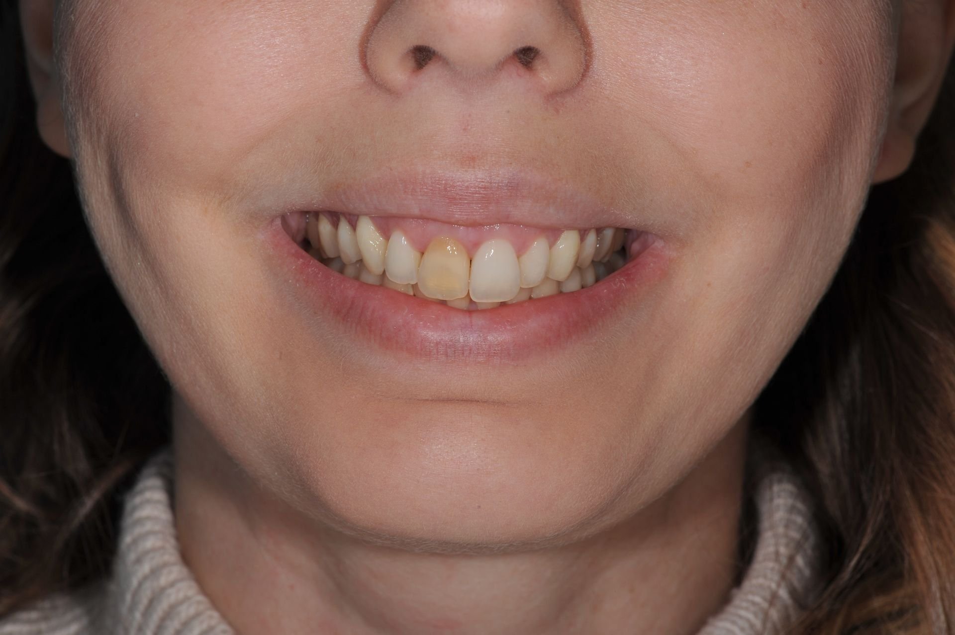 Invisalign, bielenie a 1 keramická korunka – pred