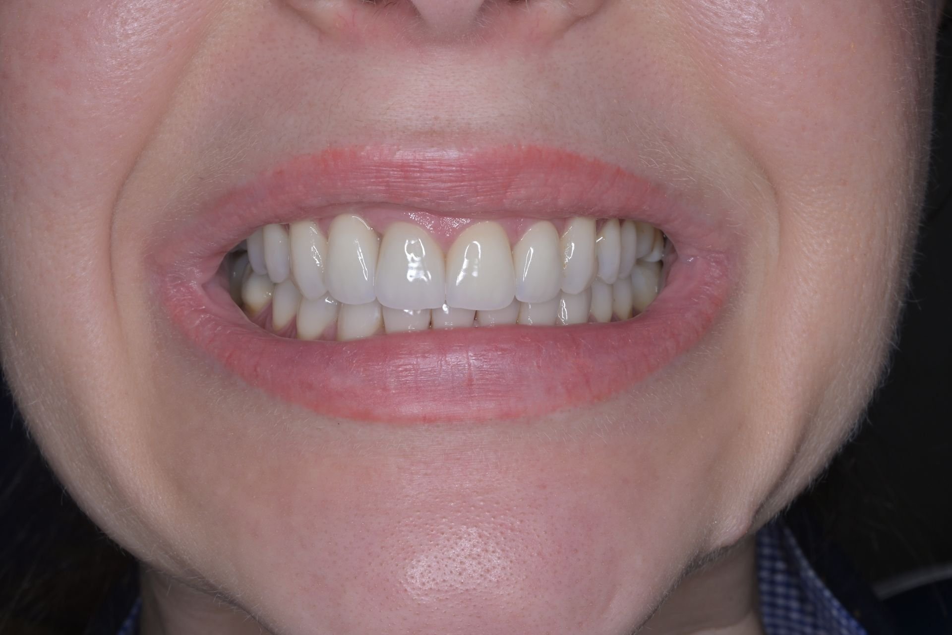 Profesionálne bielenie a 4 keramické korunky  – po