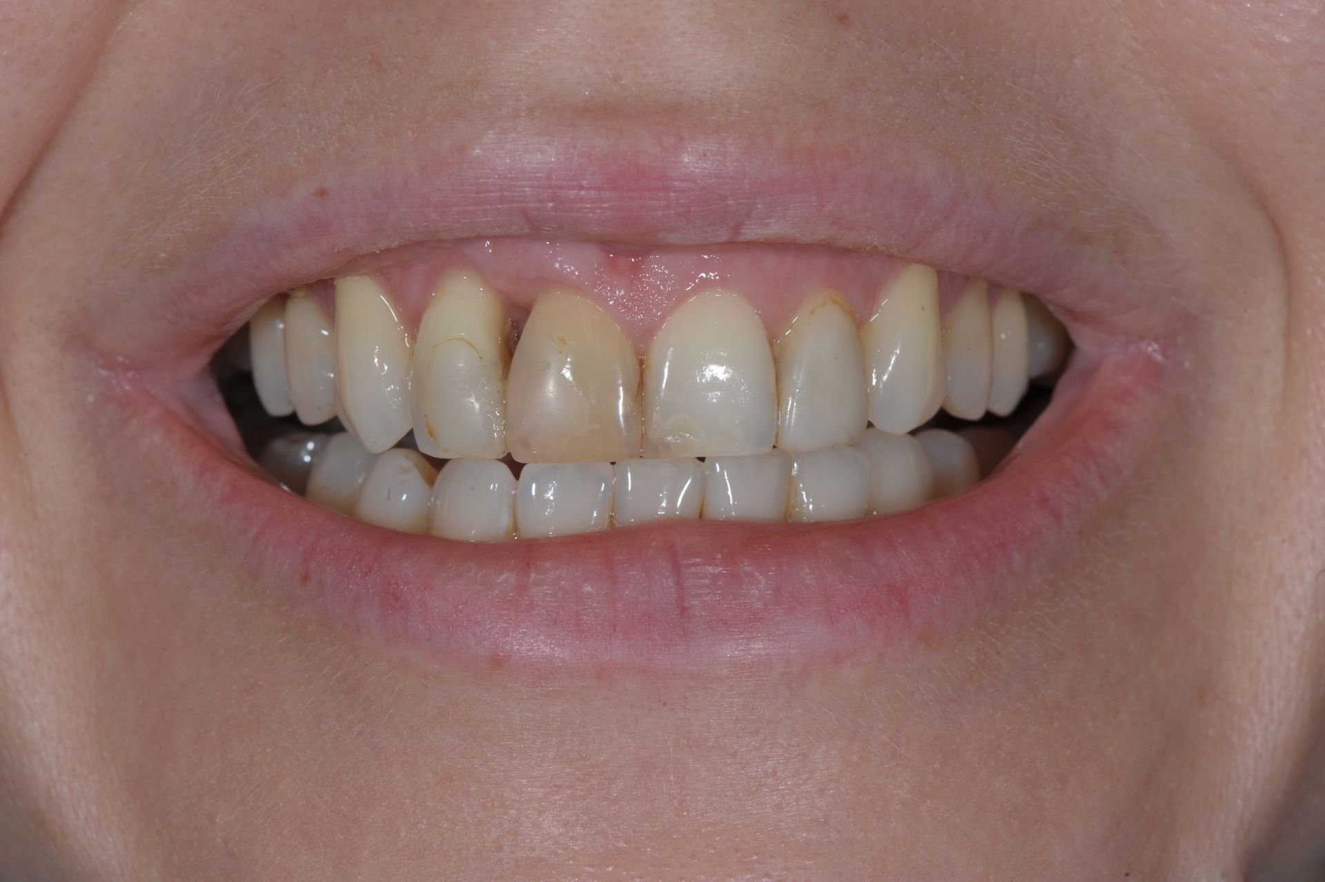 Profesionálne bielenie a 4 keramické korunky  – pred