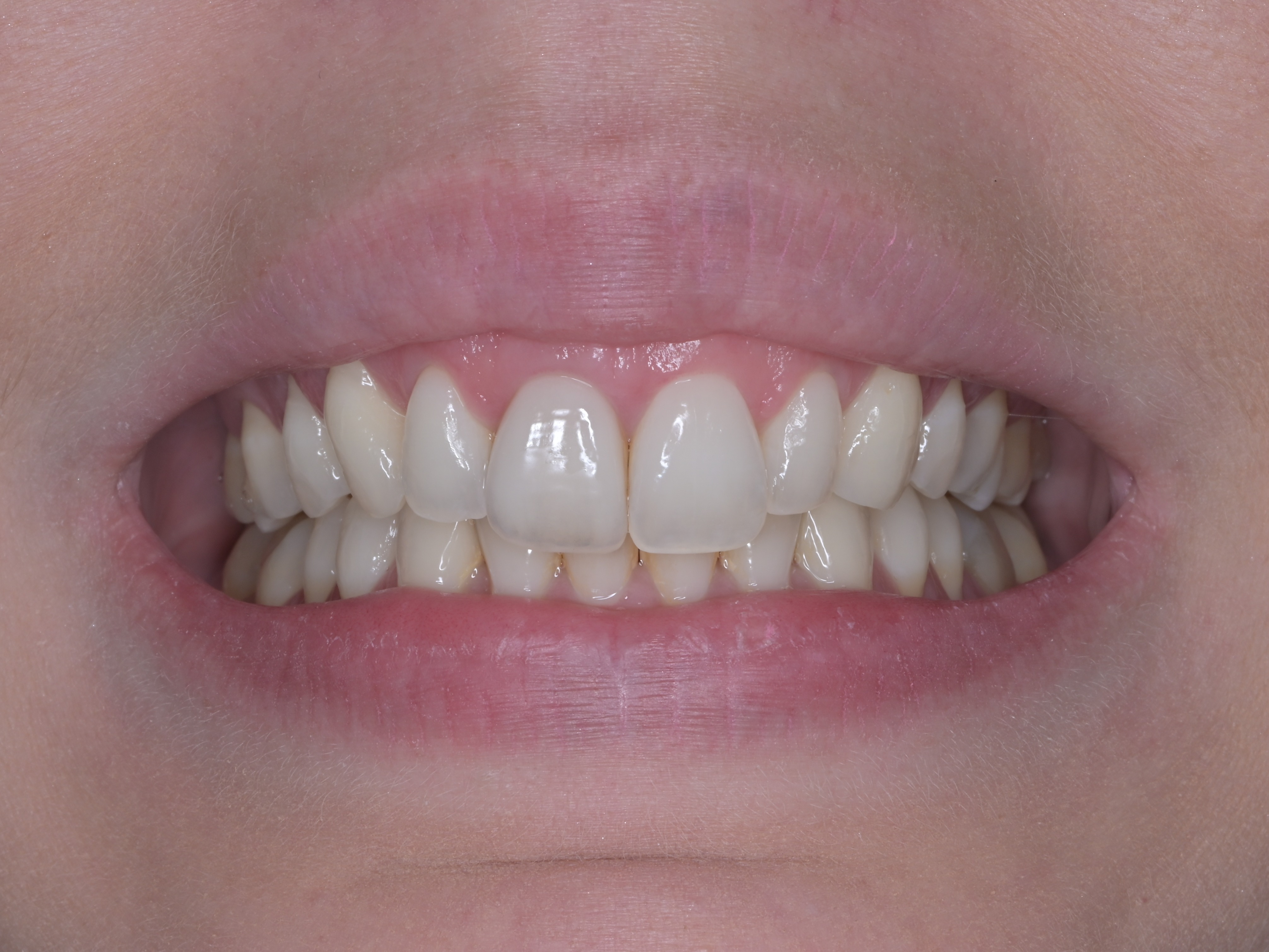 Invisalign, bielenie a 1 keramická korunka – po