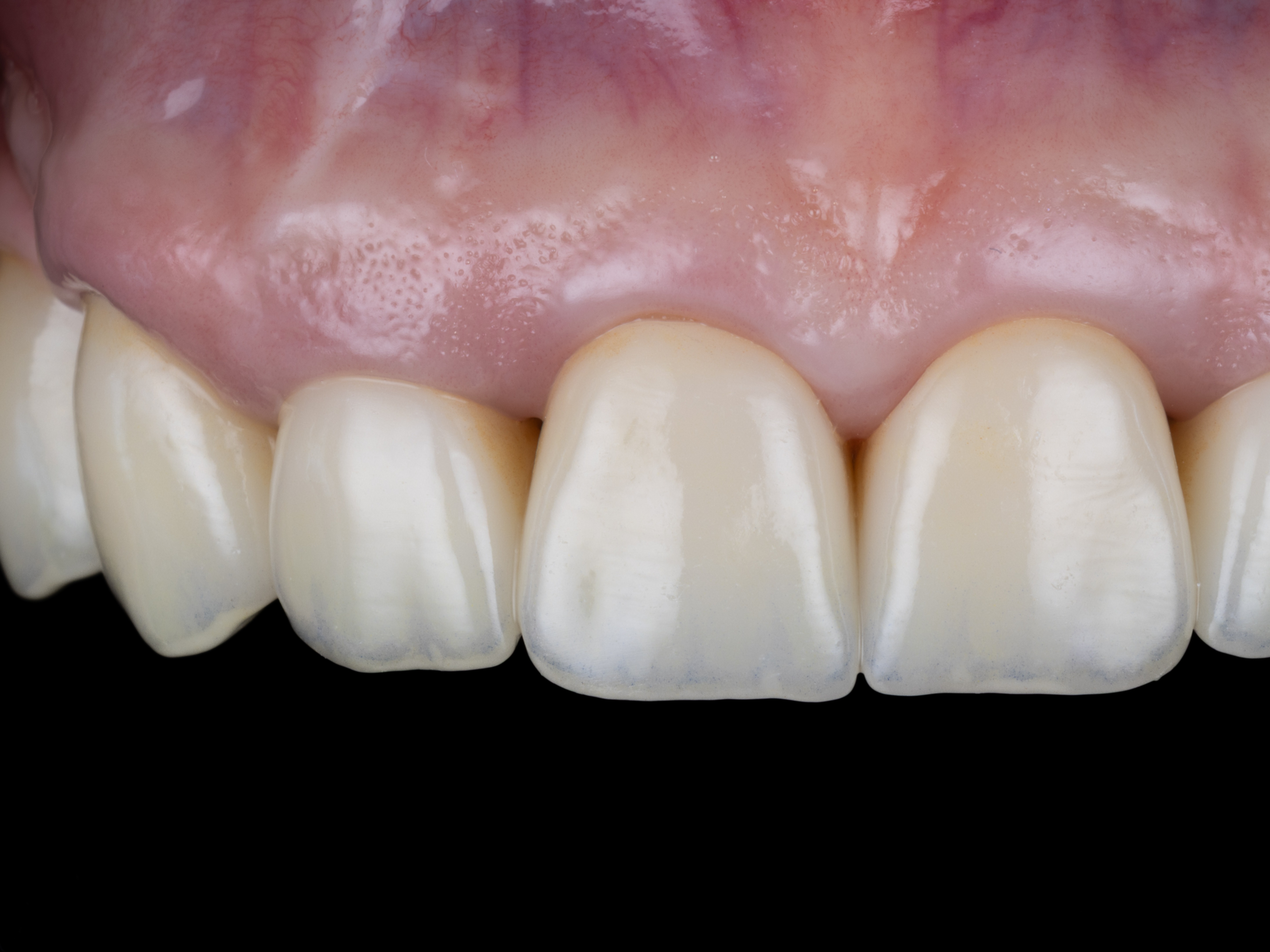 Estetická rekonštrukcia, korunky na zuboch a implantátoch – po