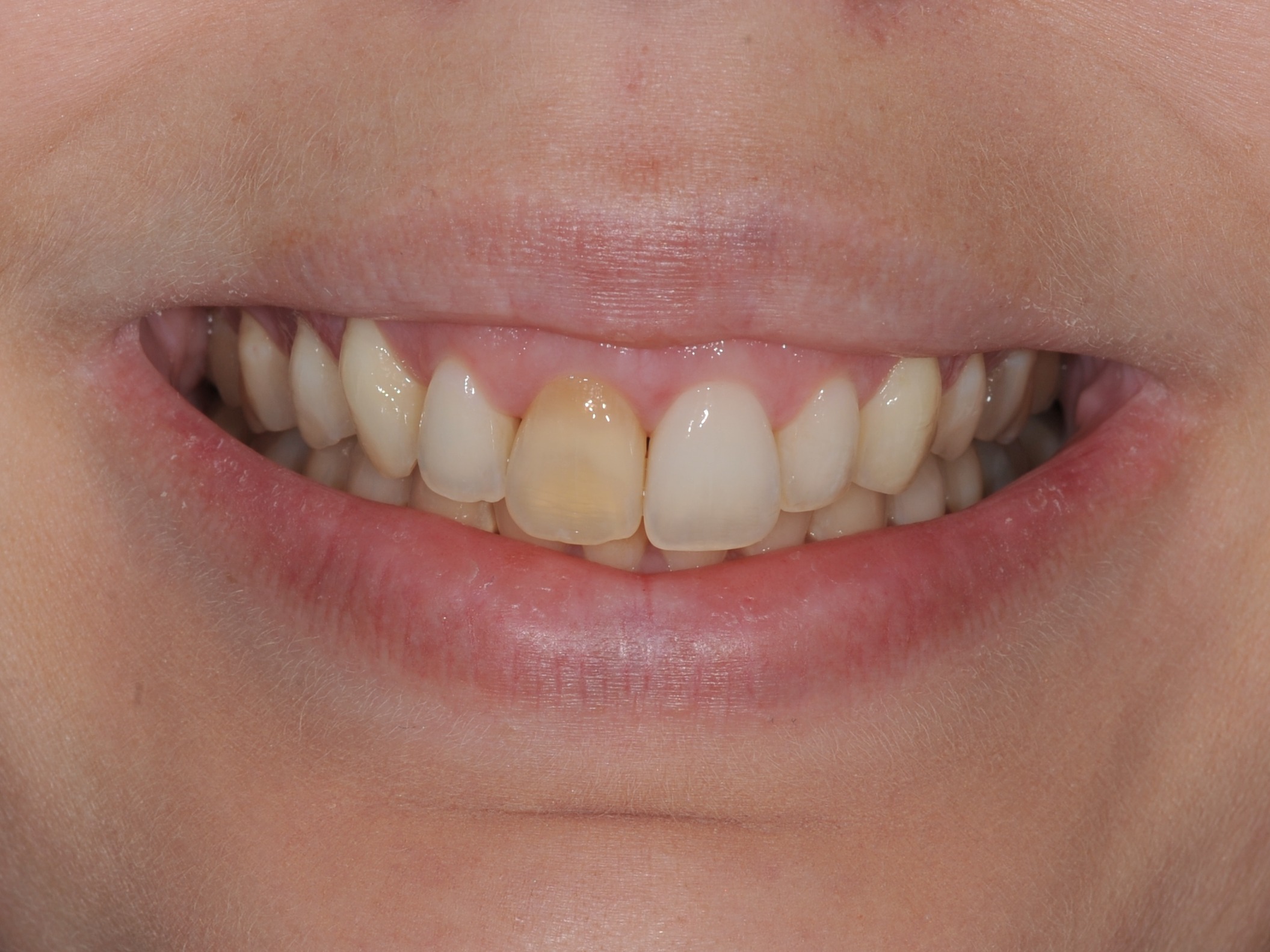 Invisalign, bielenie a 1 keramická korunka – pred