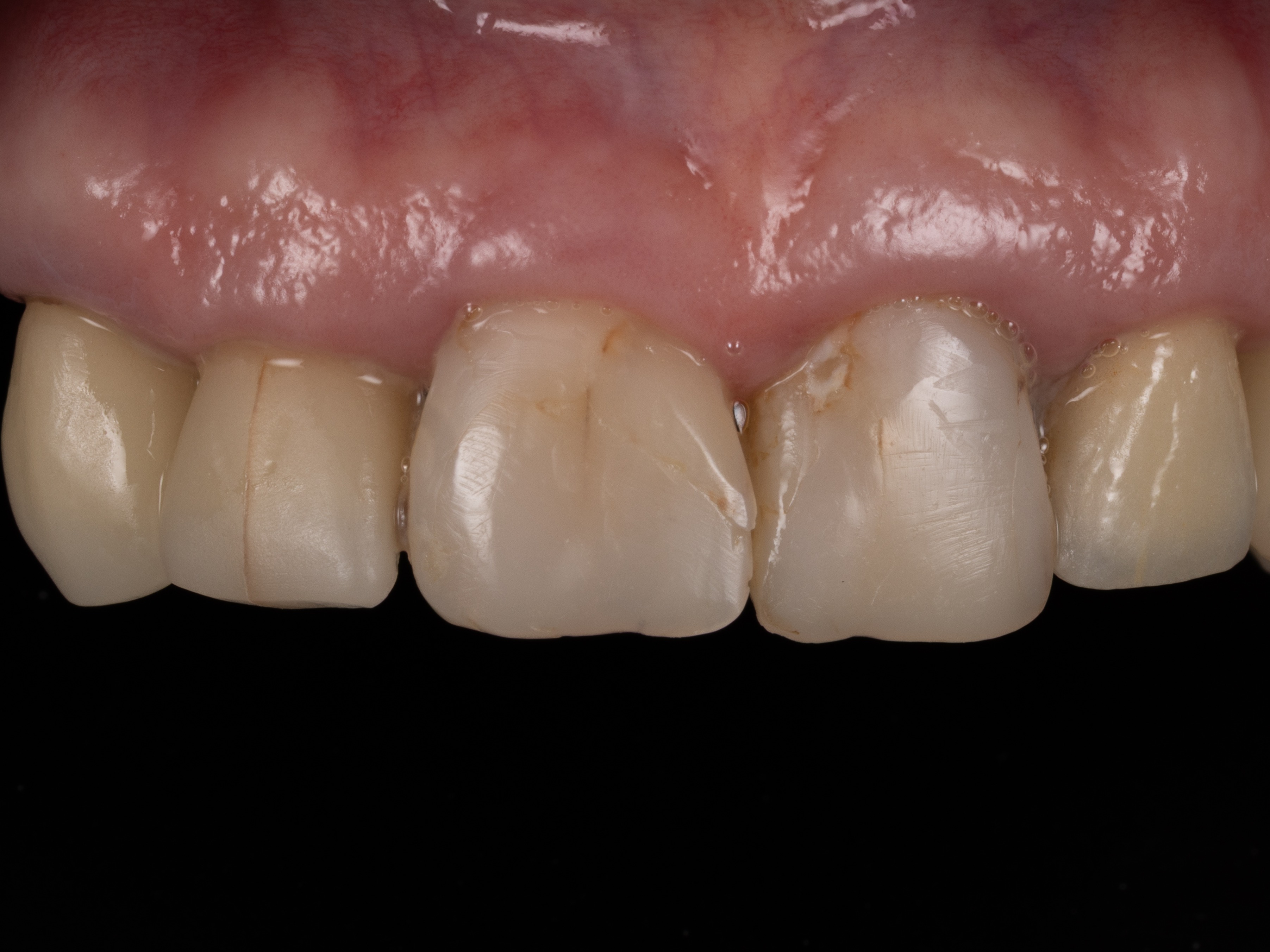 Estetická rekonštrukcia, korunky na zuboch a implantátoch – pred