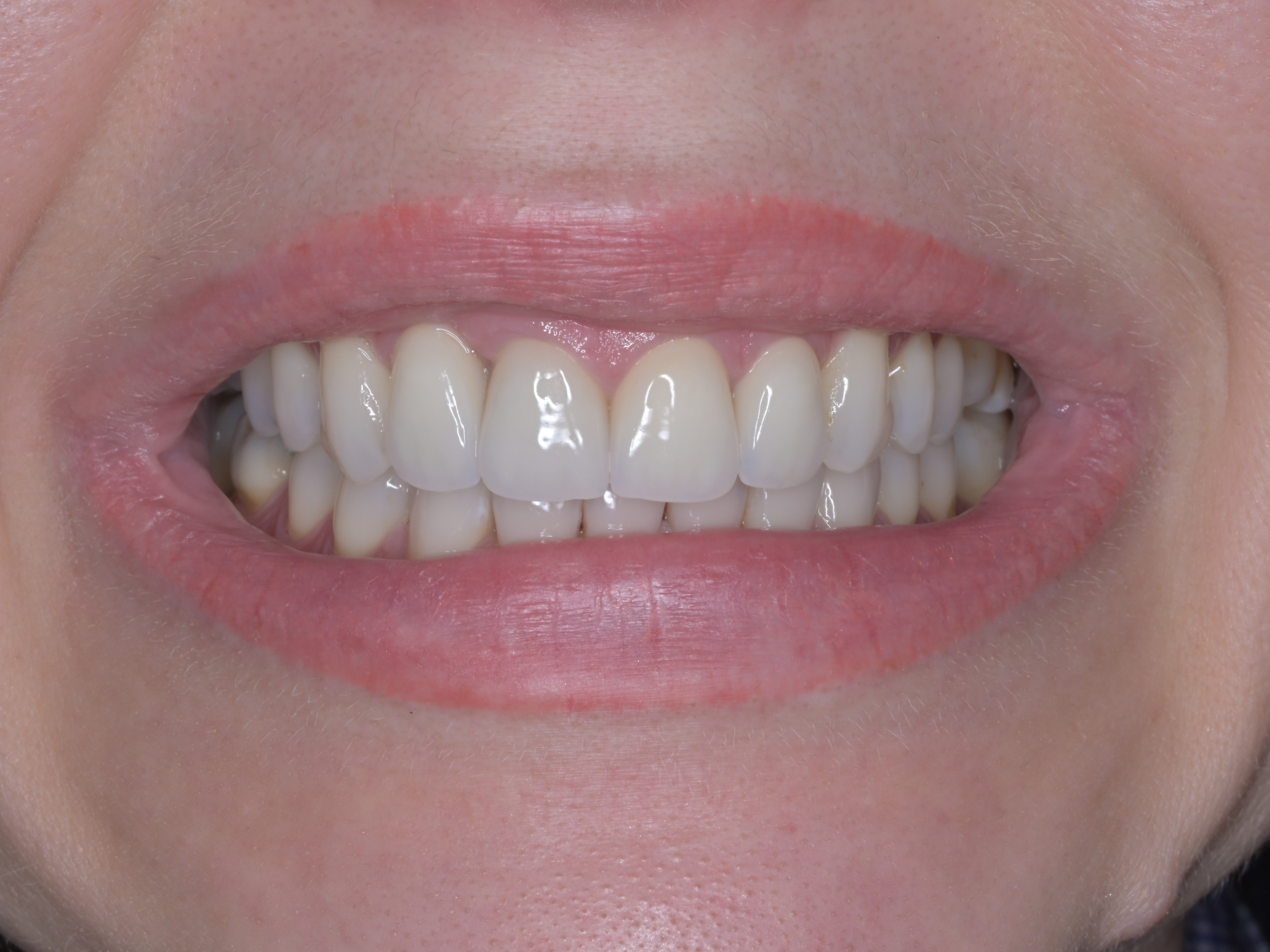 Profesionálne bielenie a 4 keramické korunky  – po