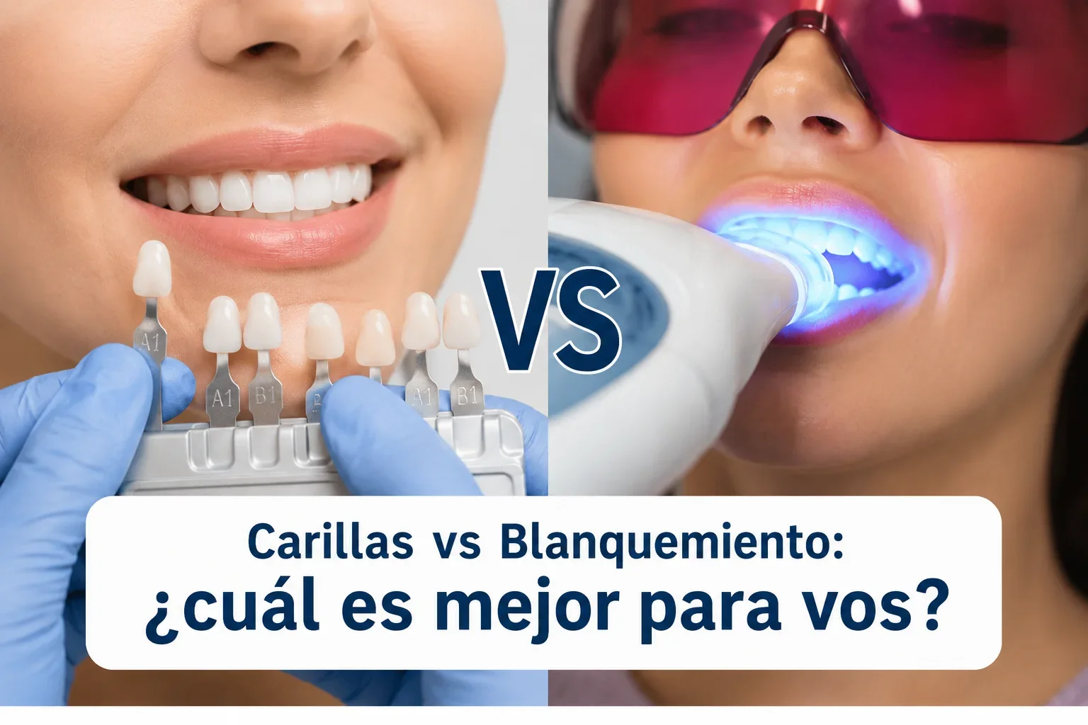 Carillas vs Blanqueamiento: ¿cuál es mejor para vos?