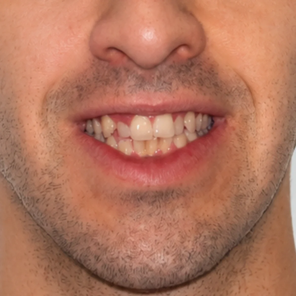 Antes