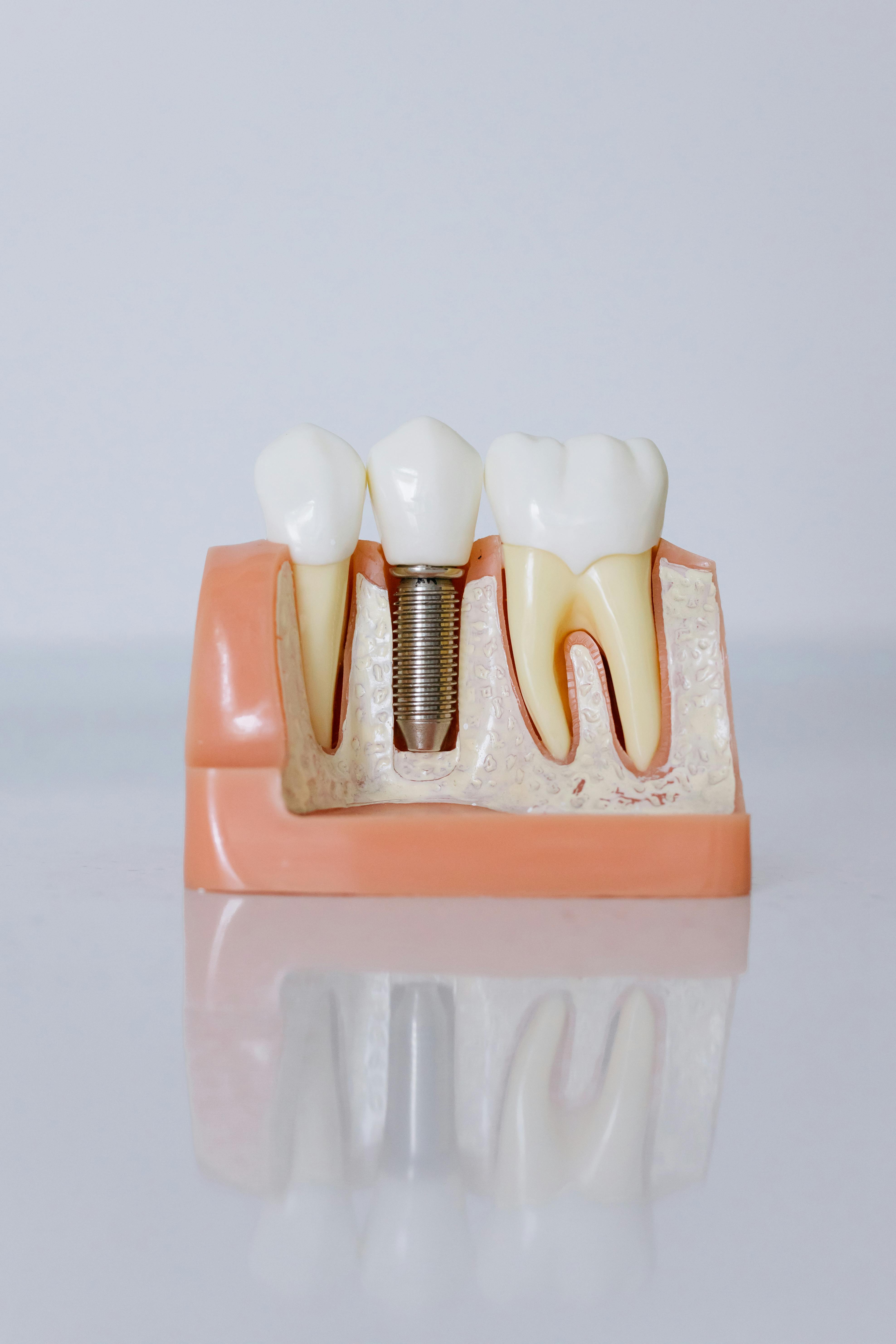 Implantes Dentales