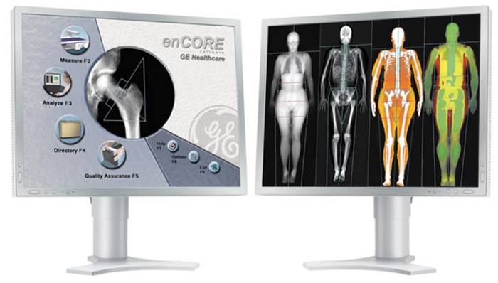 ANALYSIS SOFTWARE / DATA EXCHANGE / FOR BONE DENSITOMETRY 