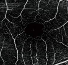 OCT-Angiography Software for RS-3000 Advance 2 AngioScan