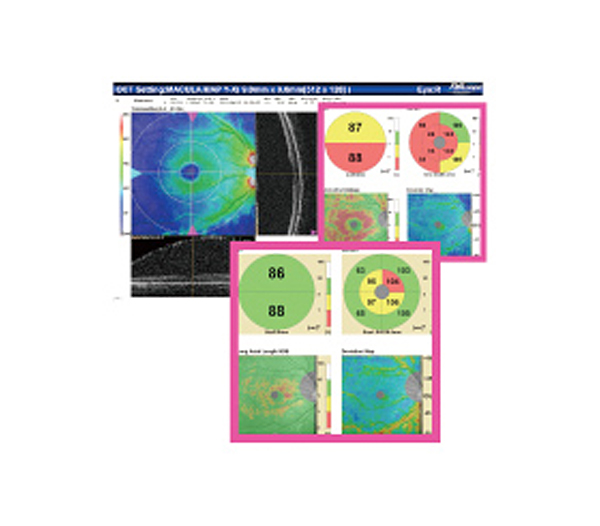 Software for RS series  Long Axial Length Normative Database