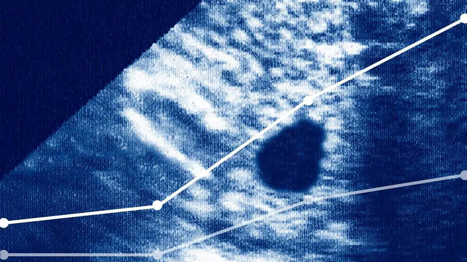 Ectopic Pregnancy Deaths Surge