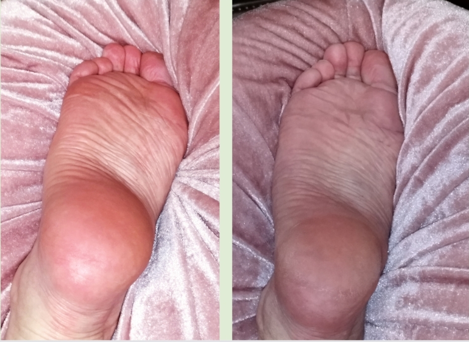 Dry Probe/ Luonnollinen ihon uudistamishoito, Jalkapohjijen hoito.