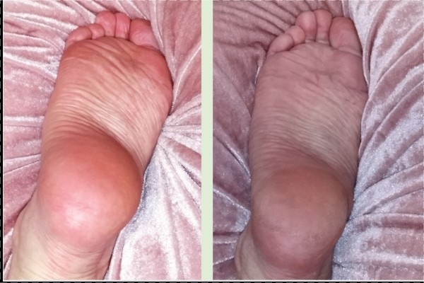 Dry Probe/ Luonnollinen ihon uudistamishoito, JALKAPOHJIEN hoito.