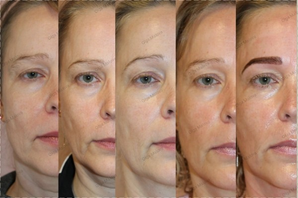 Dry Probe/ Luonnollinen ihon uudistamishoito, koko kasvo