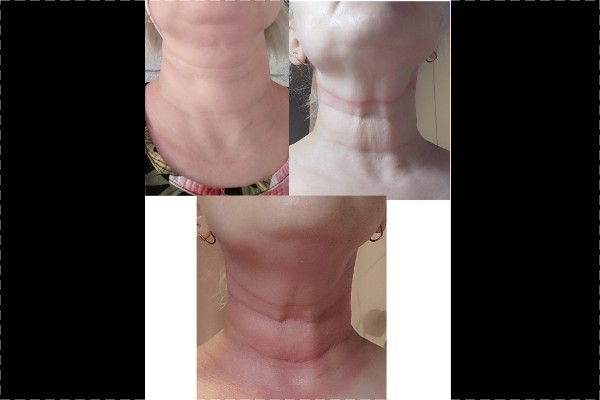 Dry Probe/ leuka,kaula ja dekolte