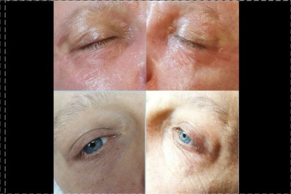 Dry Probe/ Luonnollinen ihon uudistamishoito, silmän aluet ja otsa