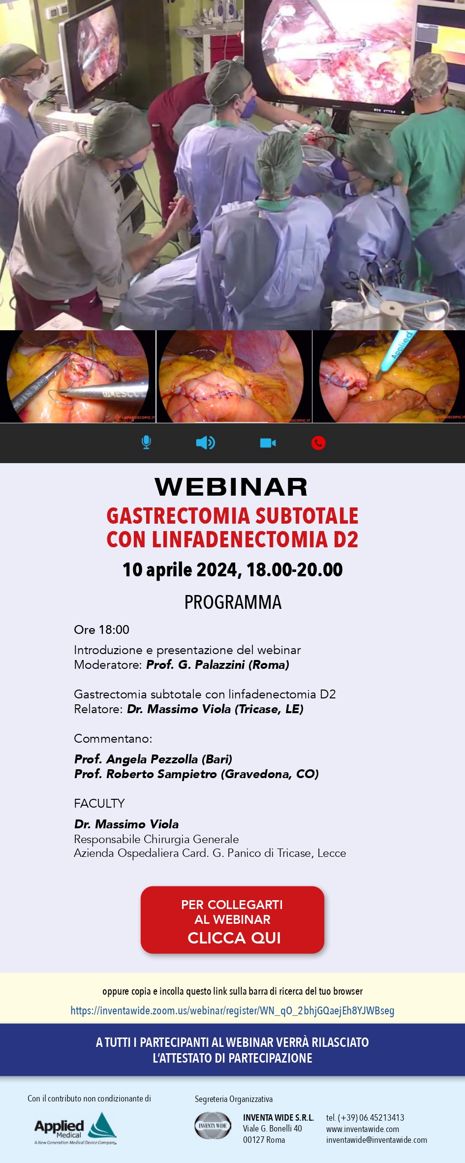 Gastrectomia subtotale con linfadenectomia D2