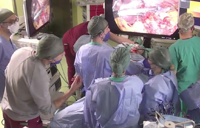 Gastrectomia subtotale con linfadenectomia D2