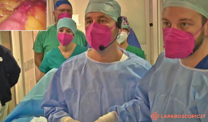 La chirurgia laparoscopica dei laparoceli: il ruolo dell'elettrochirurgia oggi
