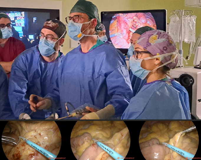 Tecniche di resezione del retto mininvasive