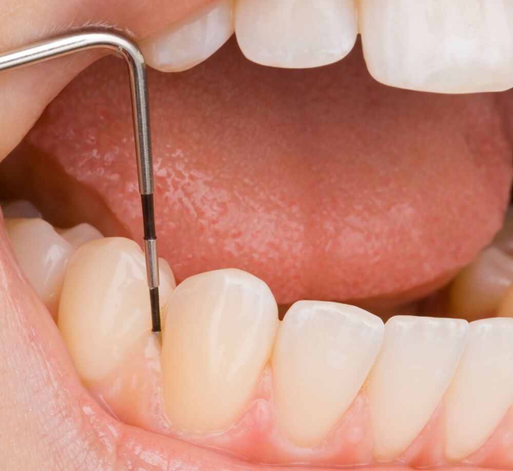 Periodoncia