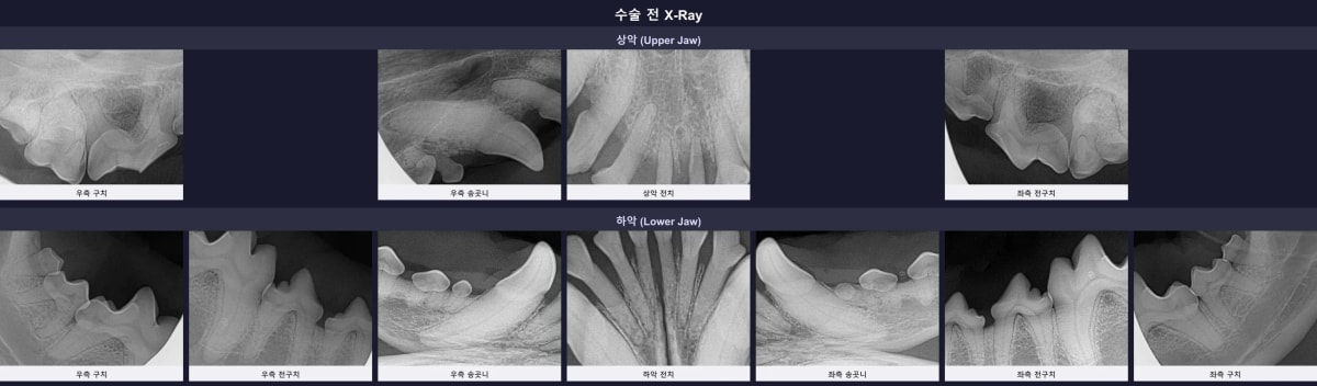 수술 전 전체 구강 방사선(X-ray) 영상으로 확인된 심각한 잇몸뼈 소실