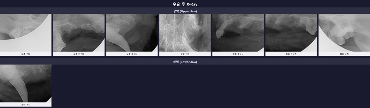 수술 후 잔존 뿌리 없이 깨끗하게 마무리된 전체 구강 방사선 영상