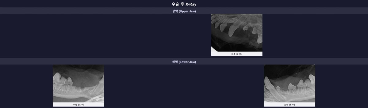 잔존 뿌리 없이 깔끔하게 완료된 수술 후 엑스레이