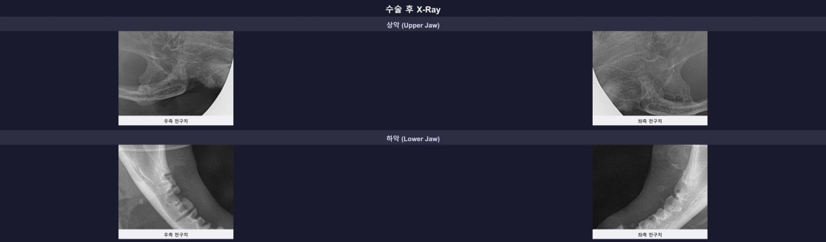 뿌리 없이 완벽하게 발치된 수술 후 엑스레이 검사 결과