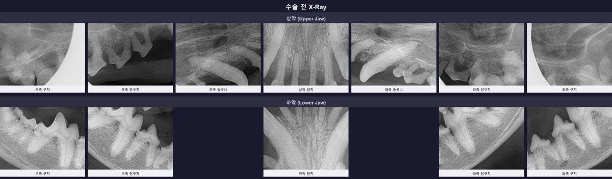 다수의 치조골 흡수와 치근단 염증이 확인되는 수술 전 전체 구강 엑스레이