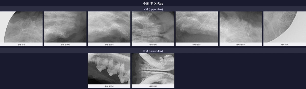 모든 문제 치아의 뿌리가 남김없이 제거된 수술 후 구강 엑스레이