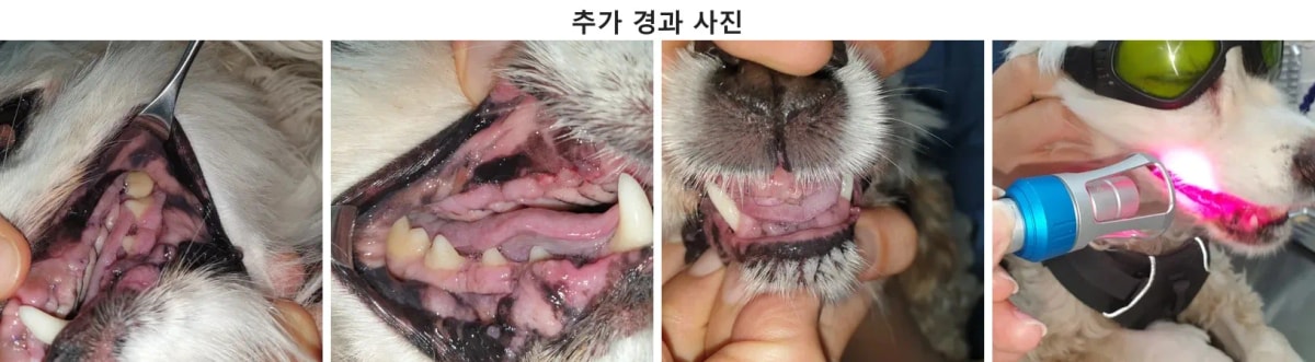 수술 후 염증과 부종이 가라앉고 잇몸이 깨끗하게 회복 중인 긍정적인 경과 모습