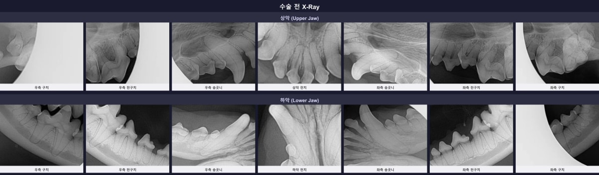 수술 전 촬영된 상하악 전체 구강 방사선(X-ray) 사진