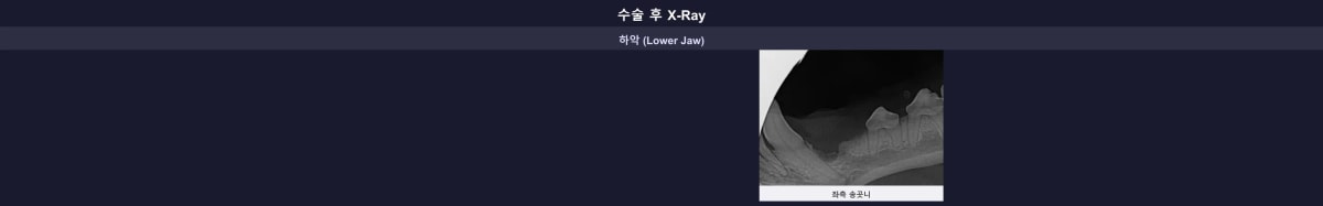 수술 후 깨끗해진 엑스레이 소견