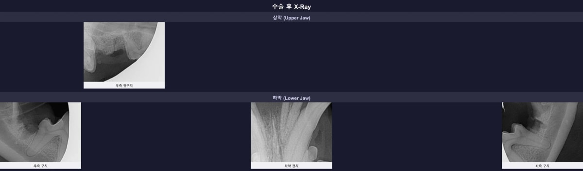 수술 후 잔존 뿌리가 남지 않은 깨끗한 엑스레이 소견