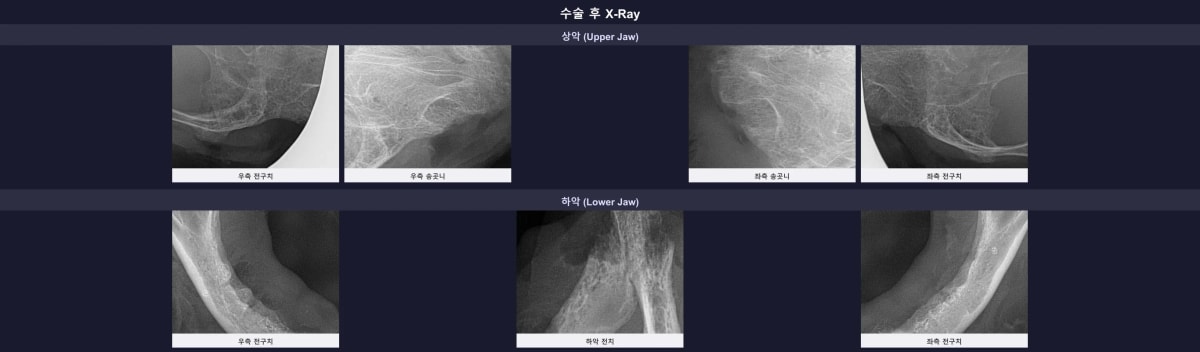 수술 후 엑스레이