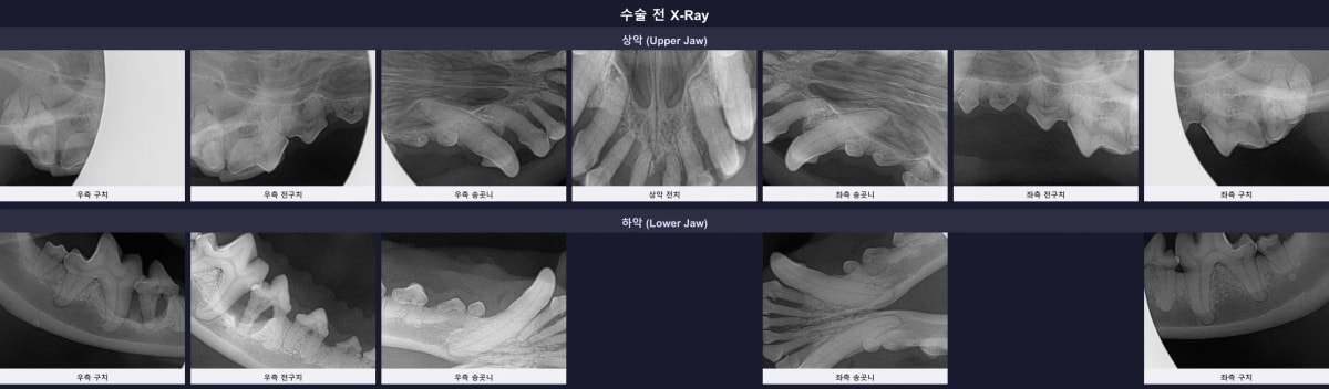 수술 전 촬영한 전체 구강 엑스레이, 심각한 치조골 흡수가 관찰됨