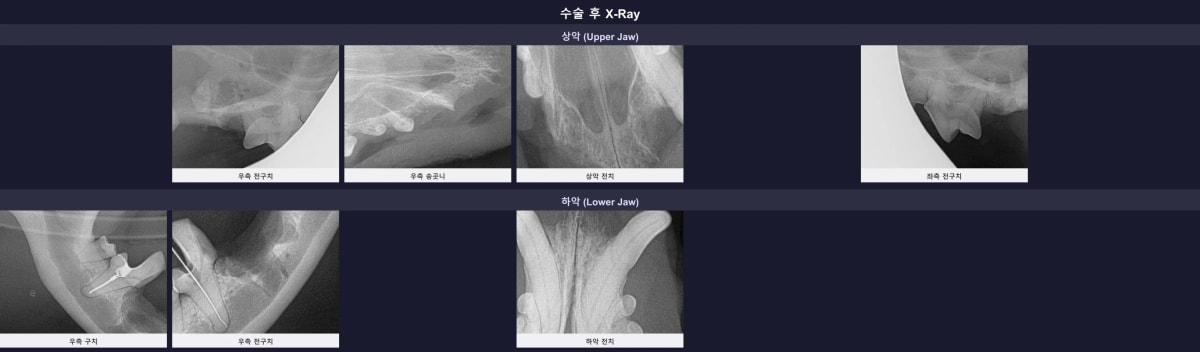 수술 후 잔존 뿌리 없이 깔끔하게 마무리된 발치 부위 엑스레이 사진